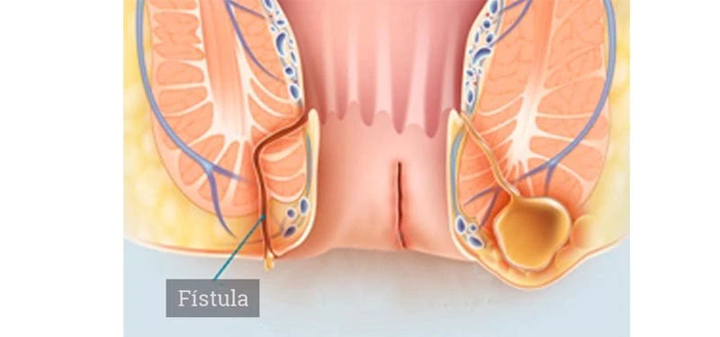 ¿Cómo eliminar la fístula anal?