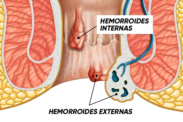 ¿Cómo Eliminar las hemorroides?